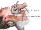 Ultrazvok vratnih žil 53, Ilustracija