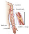 Ultrazvok arterij roke 3