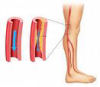 Ultrazvok arterij na nogi 1, Ilustracija aterosklerotične zožitve arterije