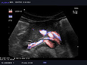 Ultrazvok ledvične arterije 7, Barvni dopler desne ledvične arterije (normalen izvid)