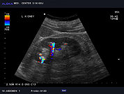 Ultrazvok ledvic 27, Ledvični kamen s pozitivnim 