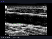 Ultrazvok vratnih žil 18, Normalen izvid IMT (debelina intime-medije)