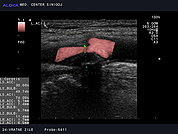 Ultrazvok vratnih žil 15, Ateroskleroza notranje karotidne arterije