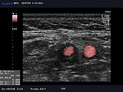 Ultrazvok vratnih žil 21, Ateroskleroza notranje karotidne arterije