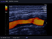 Ultrazvok vratnih žil 42, Maščobno fibrozni plak v notranji karotidni arteriji
