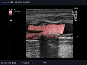 Ultrazvok vratnih žil 44, Kalciniran plak v bulbusu in notranji karotidni arteriji