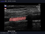 Ultrazvok vratnih žil 50, Opornica (stent) v kalcinirani arteriji